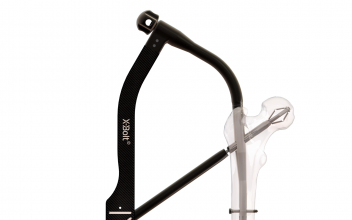 Xdo Bolt X-BOLT | Hip Fracture Fixation