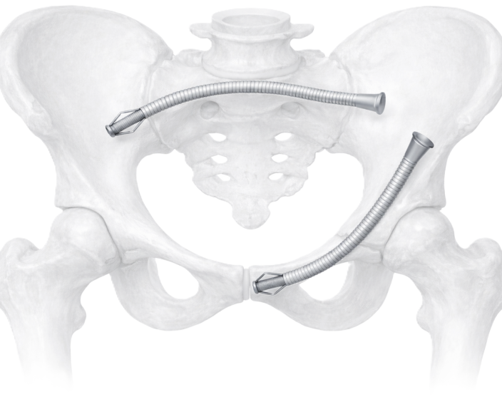TightBolt™ Pelvic Fixation