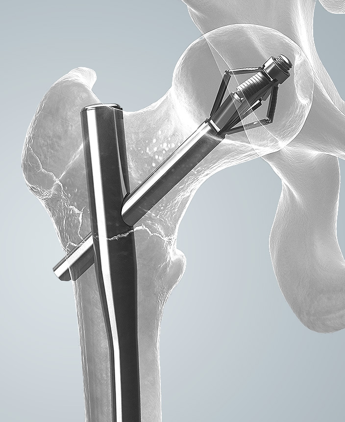 XBolt Hip Fracture Fixation