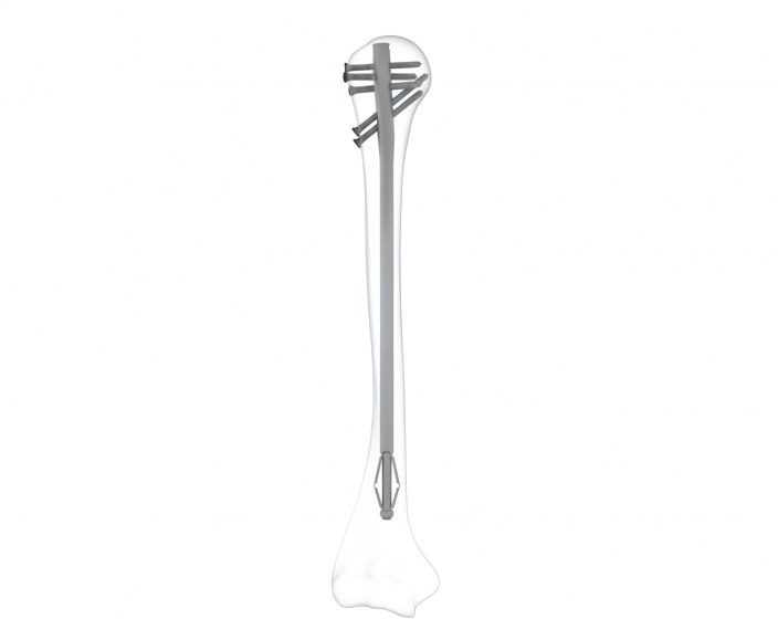 Pendulum™ Humeral Nail